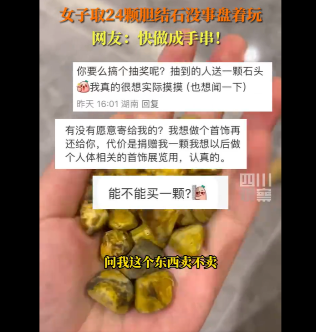 重庆29岁女生取24颗胆结石没事盘着玩，称颜色非常有光泽，很有趣