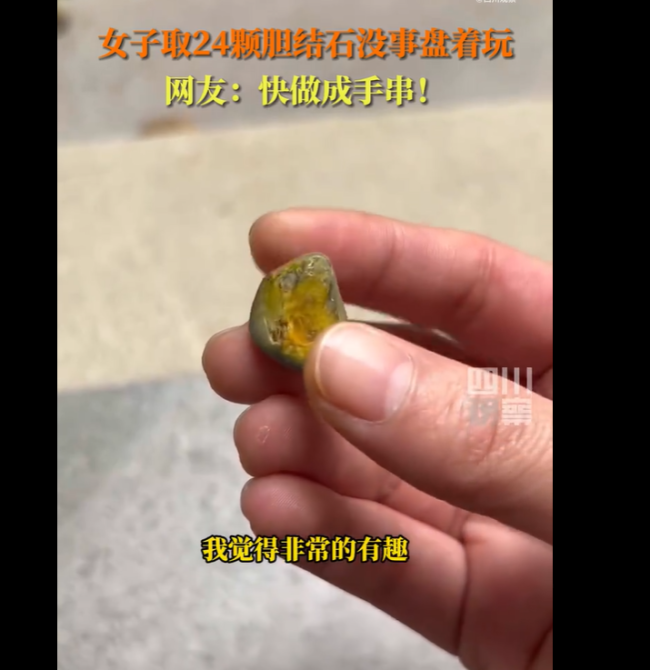 重庆29岁女生取24颗胆结石没事盘着玩，称颜色非常有光泽，很有趣